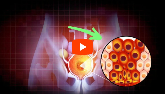 Prostate condition diagram